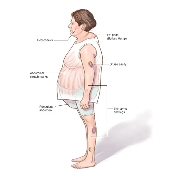 Cushings Syndrome Package Test Price In Delhi, India Ganesh Diagnostic